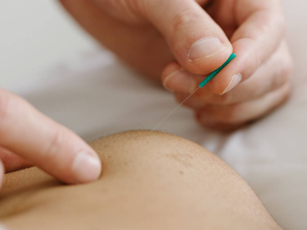 Acupuncture Treatment at Cherry Blossom Healing Arts